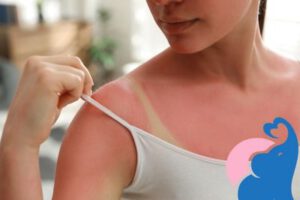 Ist Sonnenbrand in der Schwangerschaft gefährlich?